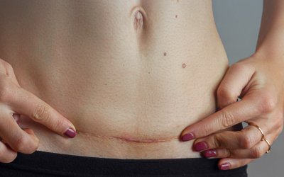 Jak správně pečovat o jizvy po operaci?