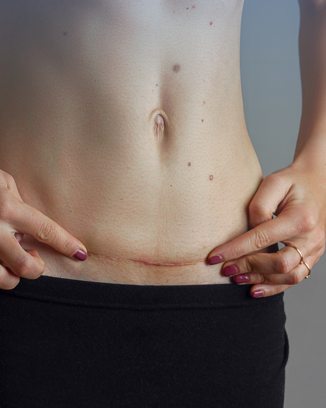 Jak správně pečovat o jizvy po operaci?