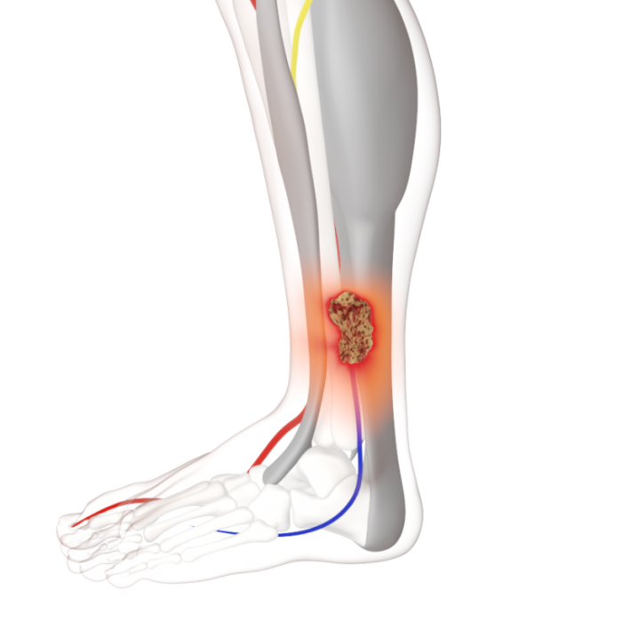 Článek o bércových vředech