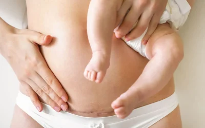 Jak správně pečovat o jizvu po císařském řezu